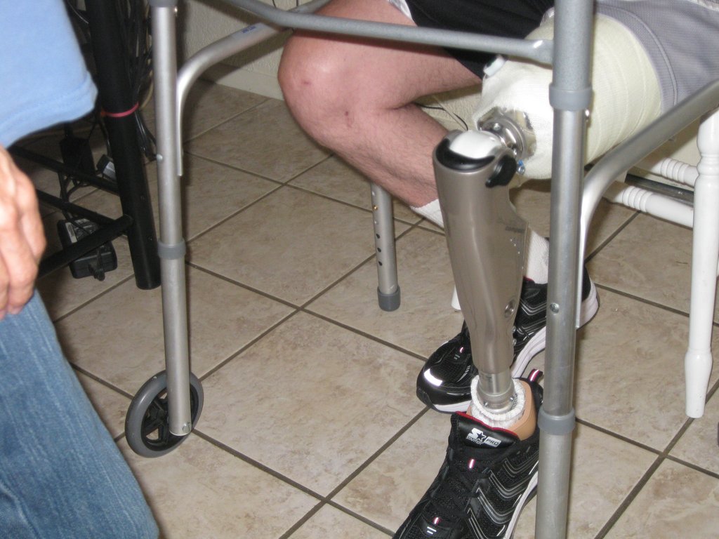 Beard practices walking on his new leg Beard practices walking on his new leg